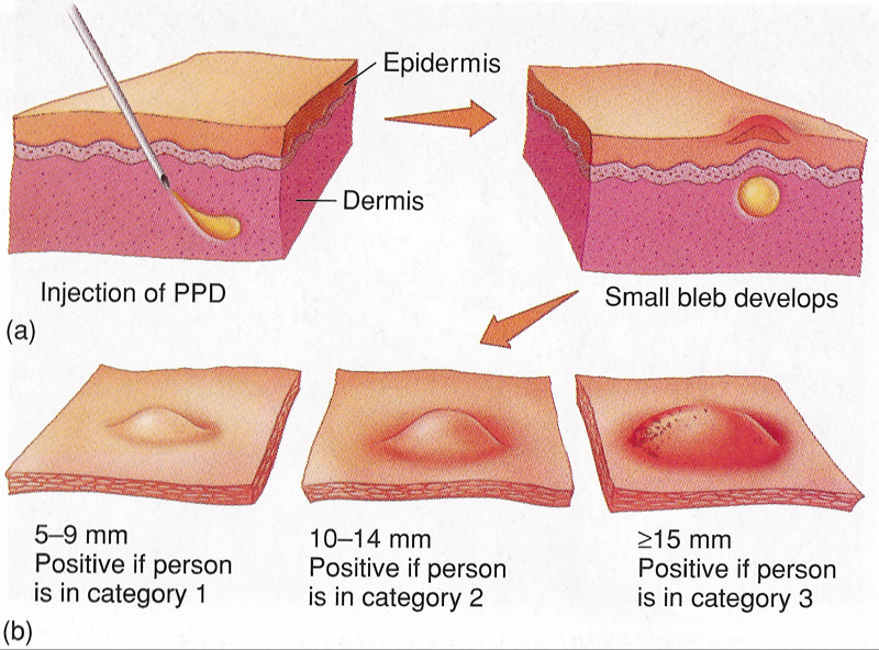 Diagnosing Tuberculosis